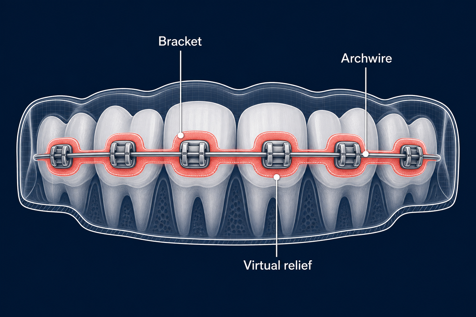 Bracket relief design